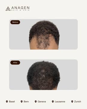 Slider image (7) Anagen - Hair Transplant Clinic in Switzerland